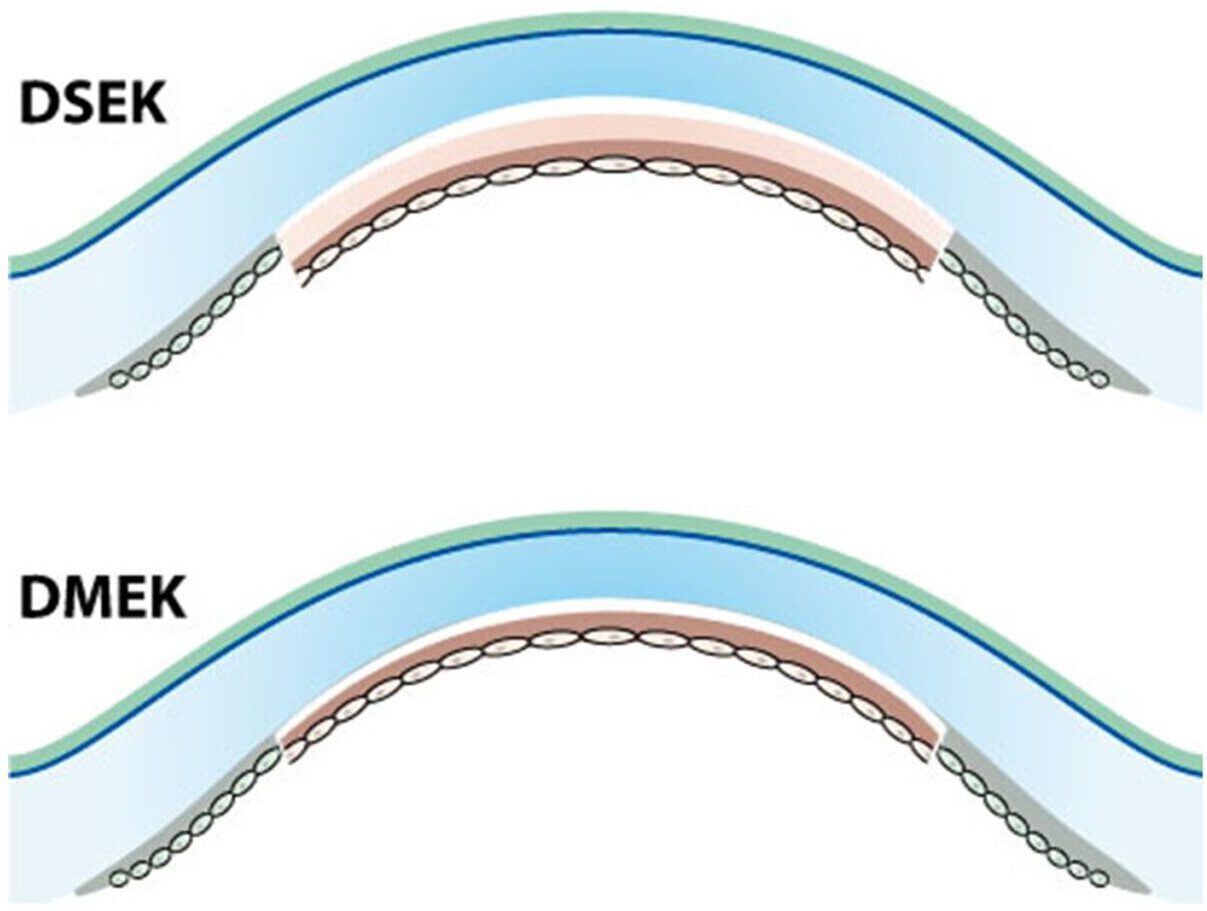 Posterieure lamellaire keratoplastiek (DSEK/DMEK) Melles