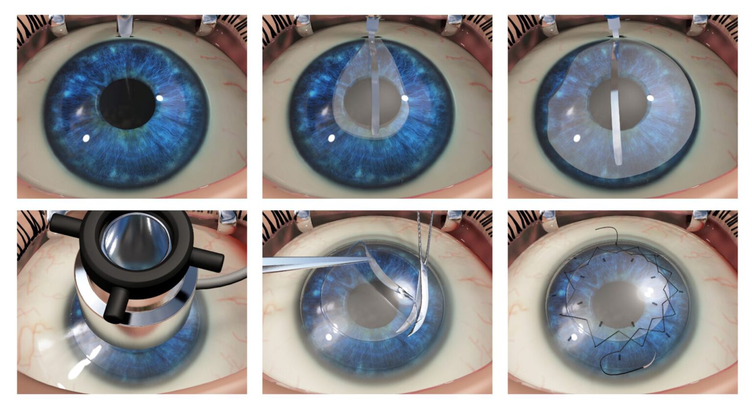 deep-anterior-lamellar-keratoplasty-dalk-niios