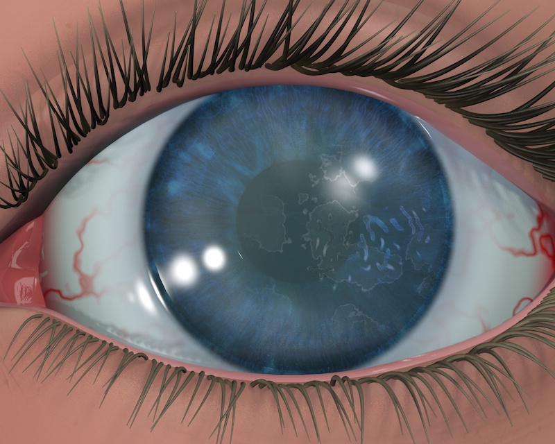 Map-Dot-Fingerprint dystrophy - Niios